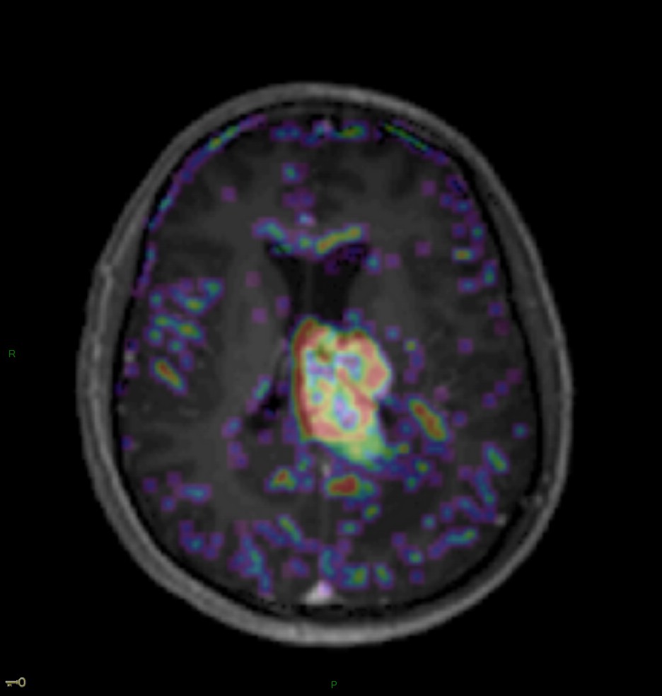 Localisation cérébrale d'un lymphome B à grandes cellules diffus, EBV négatif