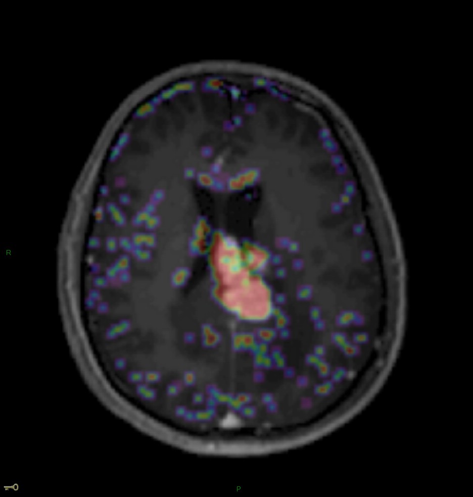 Localisation cérébrale d'un lymphome B à grandes cellules diffus, EBV négatif