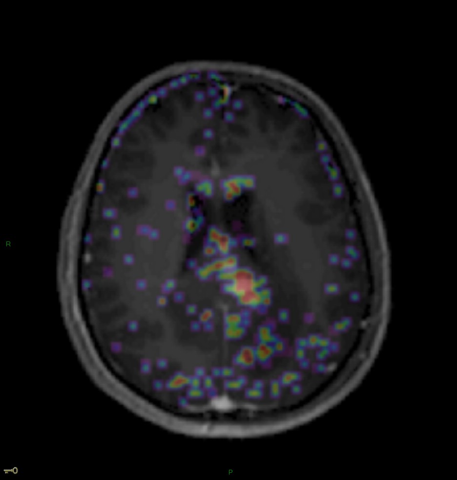 Localisation cérébrale d'un lymphome B à grandes cellules diffus, EBV négatif