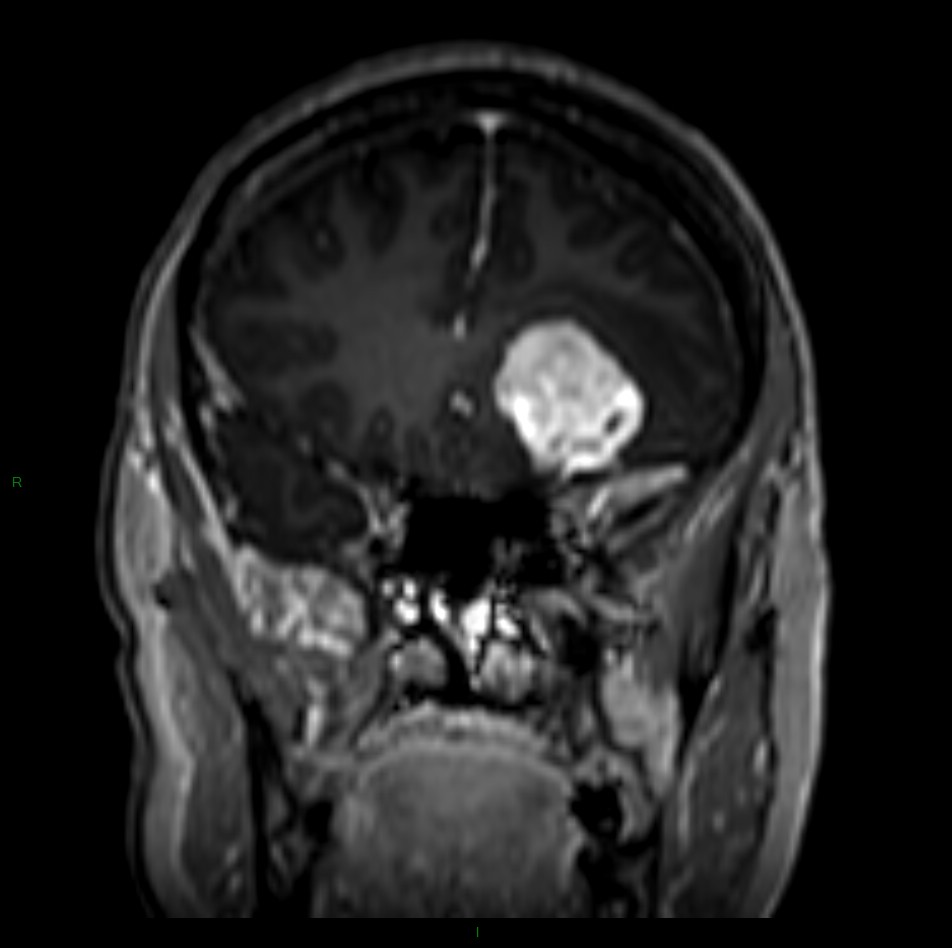 Tumeurs neuro – Méningiome – PinkyBone