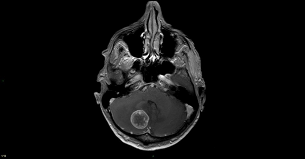 Métastase cérébelleuse droite