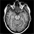 Polymicrogyrie