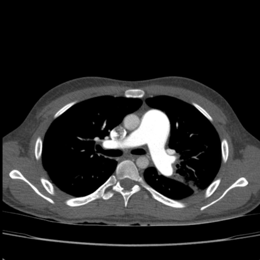 Hypertension artérielle pulmonaire HTAP