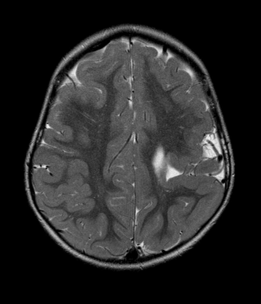 Schizencephalie