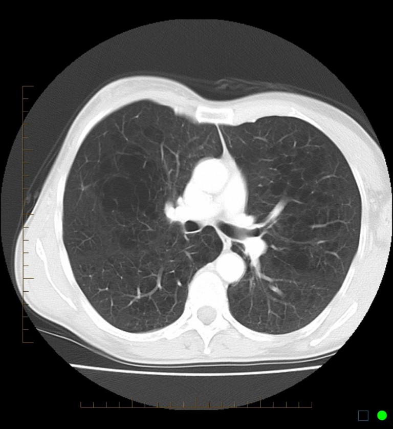severecentrilobularemphysema PinkyBone