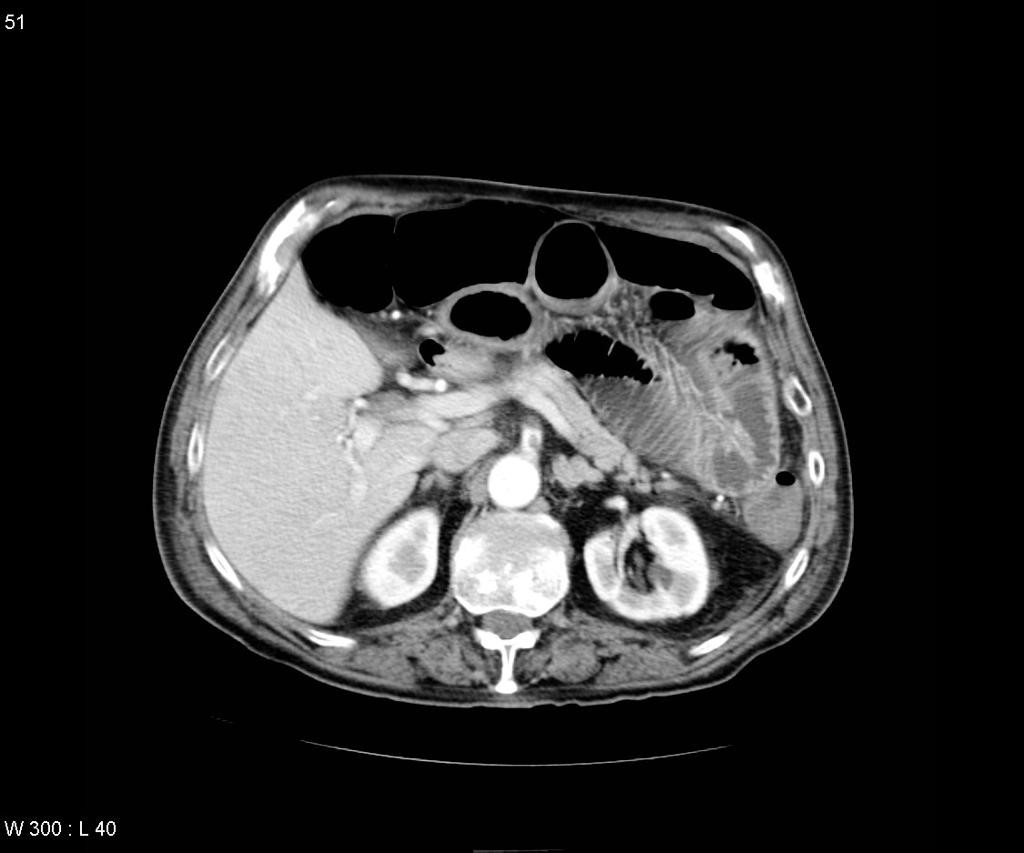 Infarctus mésentérique sur thrombus de la mésentérique supérieure