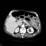 Infarctus mésentérique sur thrombus de la mésentérique supérieure