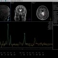 Localisation cérébrale d'un lymphome B à grandes cellules diffus, EBV négatif