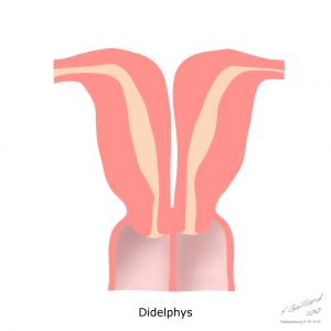 uterine-anatomical-abnormalities (2)