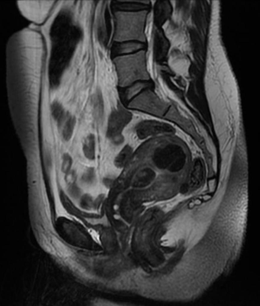 Case courtesy of Radiopaedia.org. From the case rID: 12063