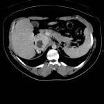 Adénocarcinome surrénalien