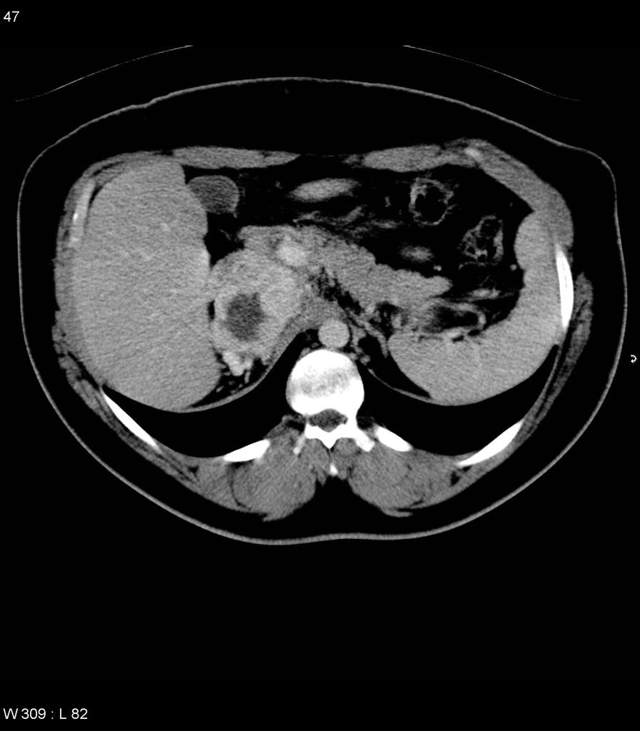 Adénocarcinome surrénalien