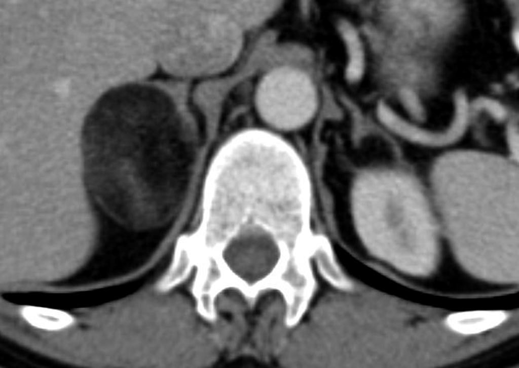 Myélolipome surrénalien