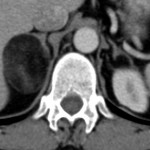 Myélolipome surrénalien