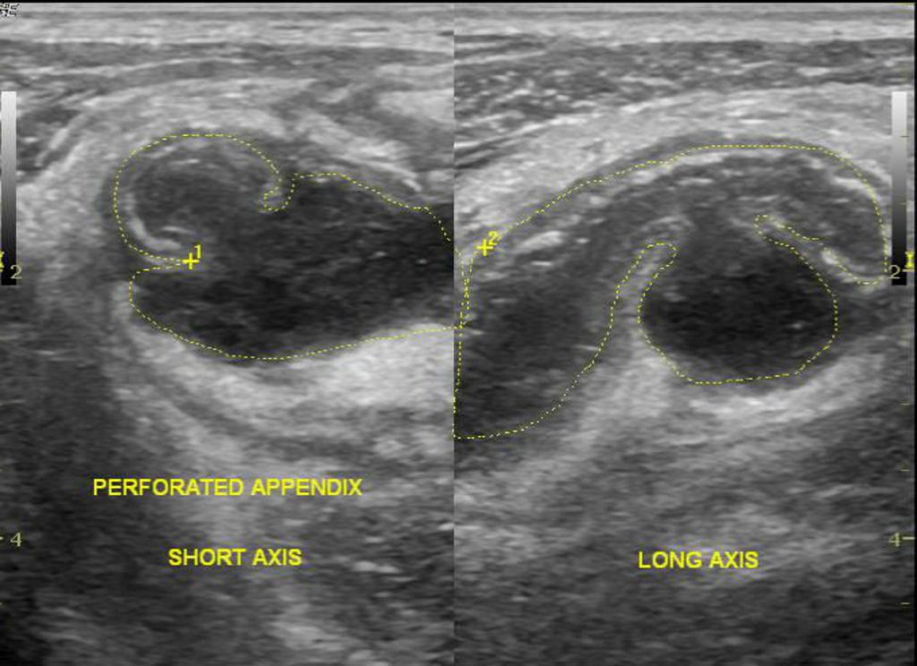 На узи видно аппендицит. УЗИ червеобразного отростка. Аппендикулярный абсцесс. Мукоцеле аппендикса гистология.