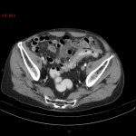 Sigmoïdite diverticulaire avec abcès