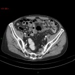 Sigmoïdite diverticulaire avec abcès