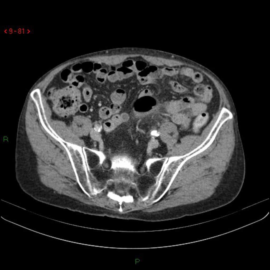 Sigmoïdite diverticulaire avec abcès