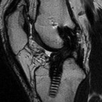 ACL graft impingement