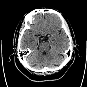 AVC : hyperdensité spontanée de l'artère sylvienne gauche