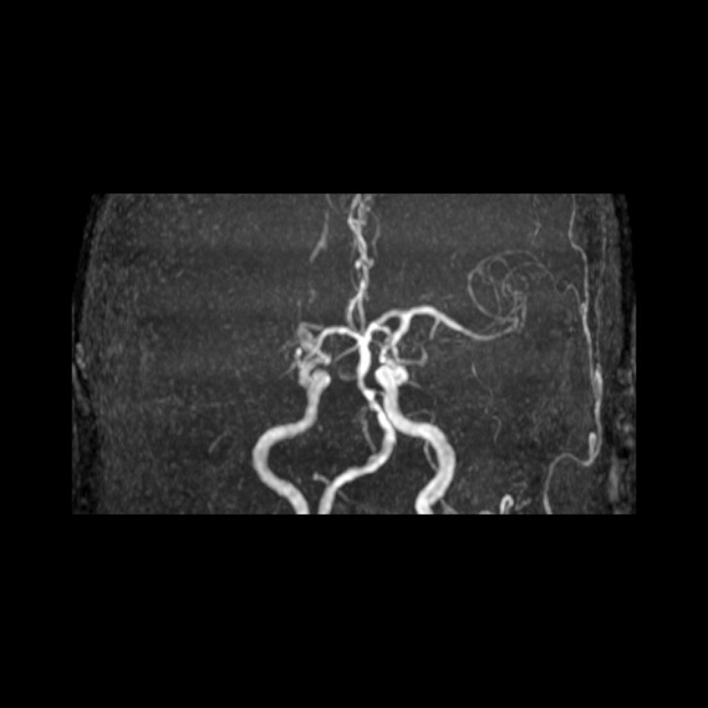 AVC : occlusion complète de l'artère sylvienne droite sur le 3D TOF