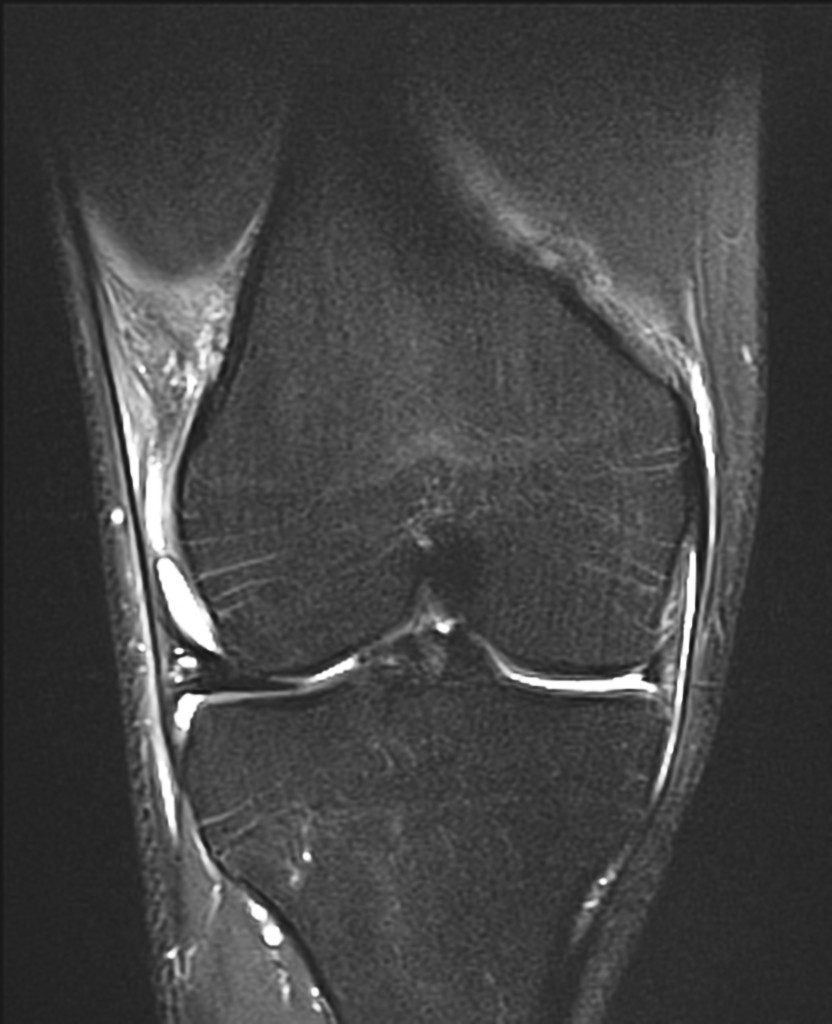 Genou – Lésions ligamentaires – PinkyBone