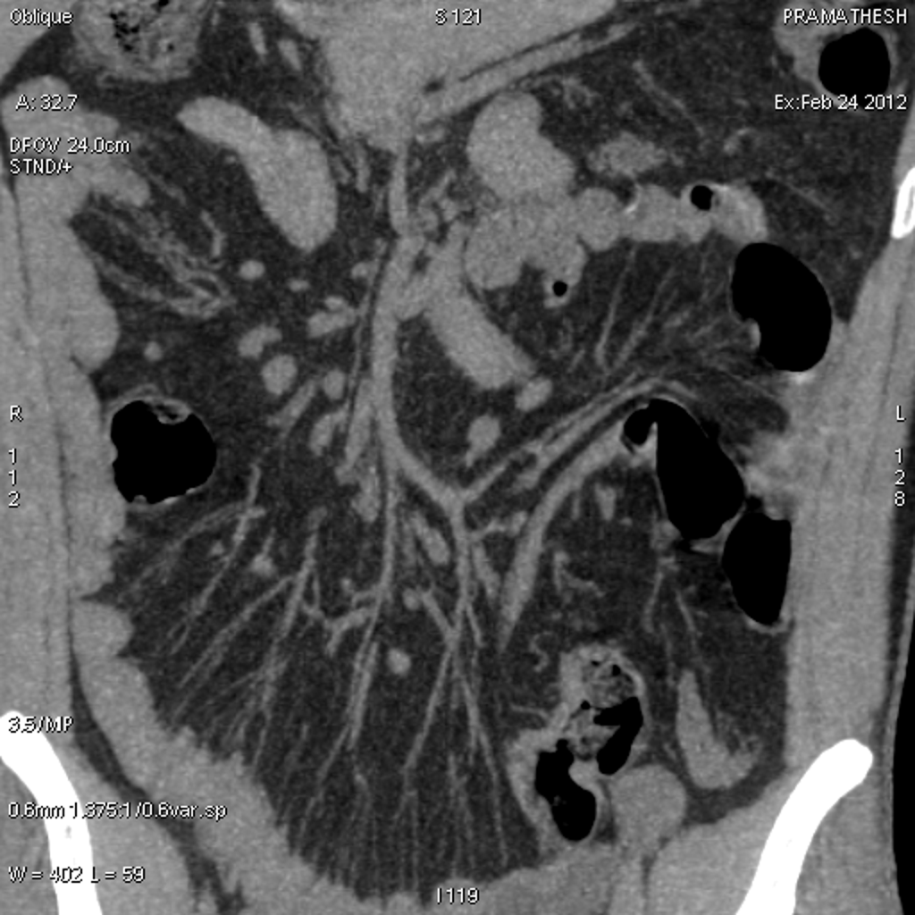 MICI : signe du peigne dans la maladie de Crohn