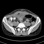 Maladie de Crohn avec signe du peigne