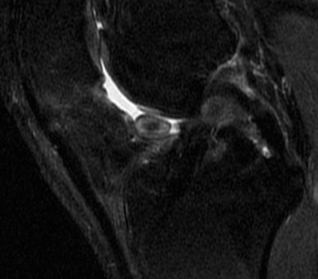 Cyclops Lesion Cause Sports Injury Bulletin UOCYKX Cyclops Lesion Cause Sports Injury Bulletin UOCYKX