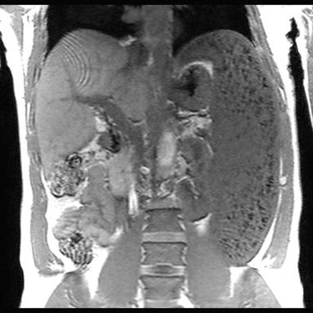 Hypertension portale : corps de Gamna Gandy