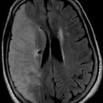 AVC : hypersignal FLAIR du territoire sylvien droit