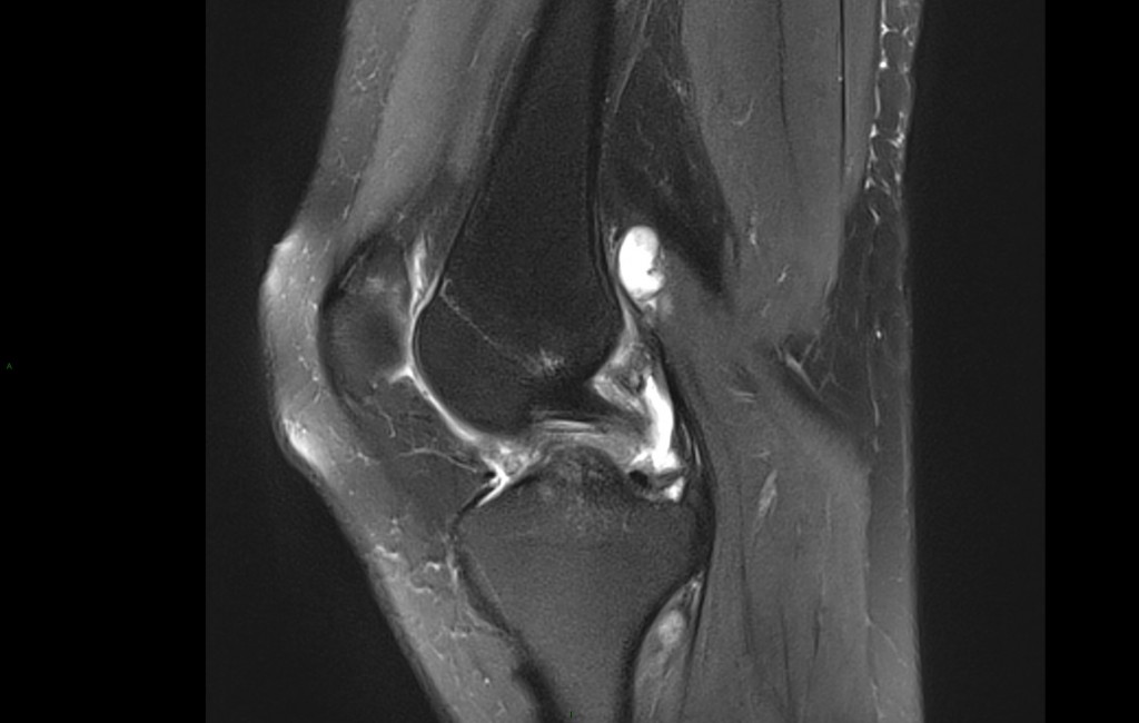 Genou L sions Ligamentaires PinkyBone