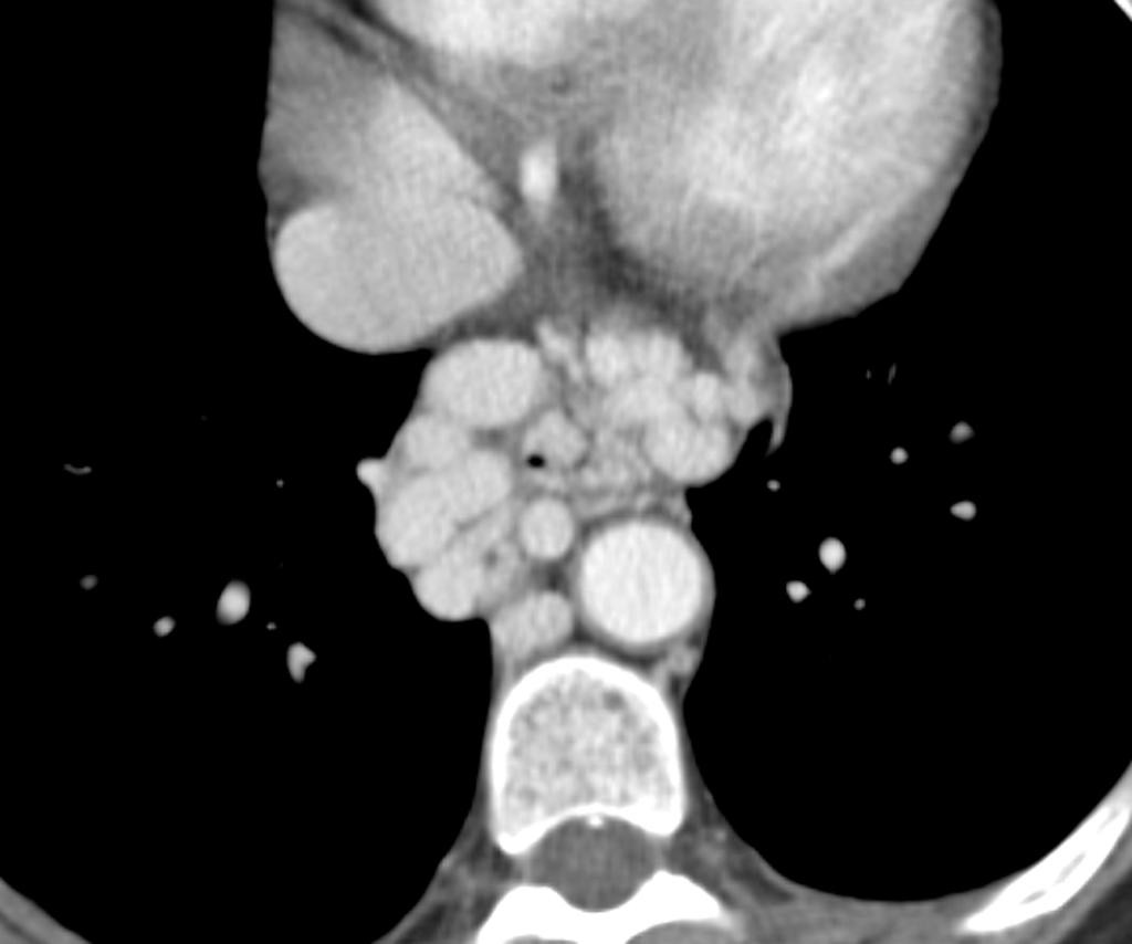 Hypertension portale : varices oesophagiennes