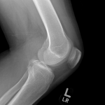 Rupture du LCP avec fracture