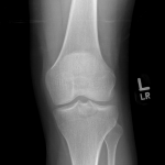 Rupture du LCP avec fracture