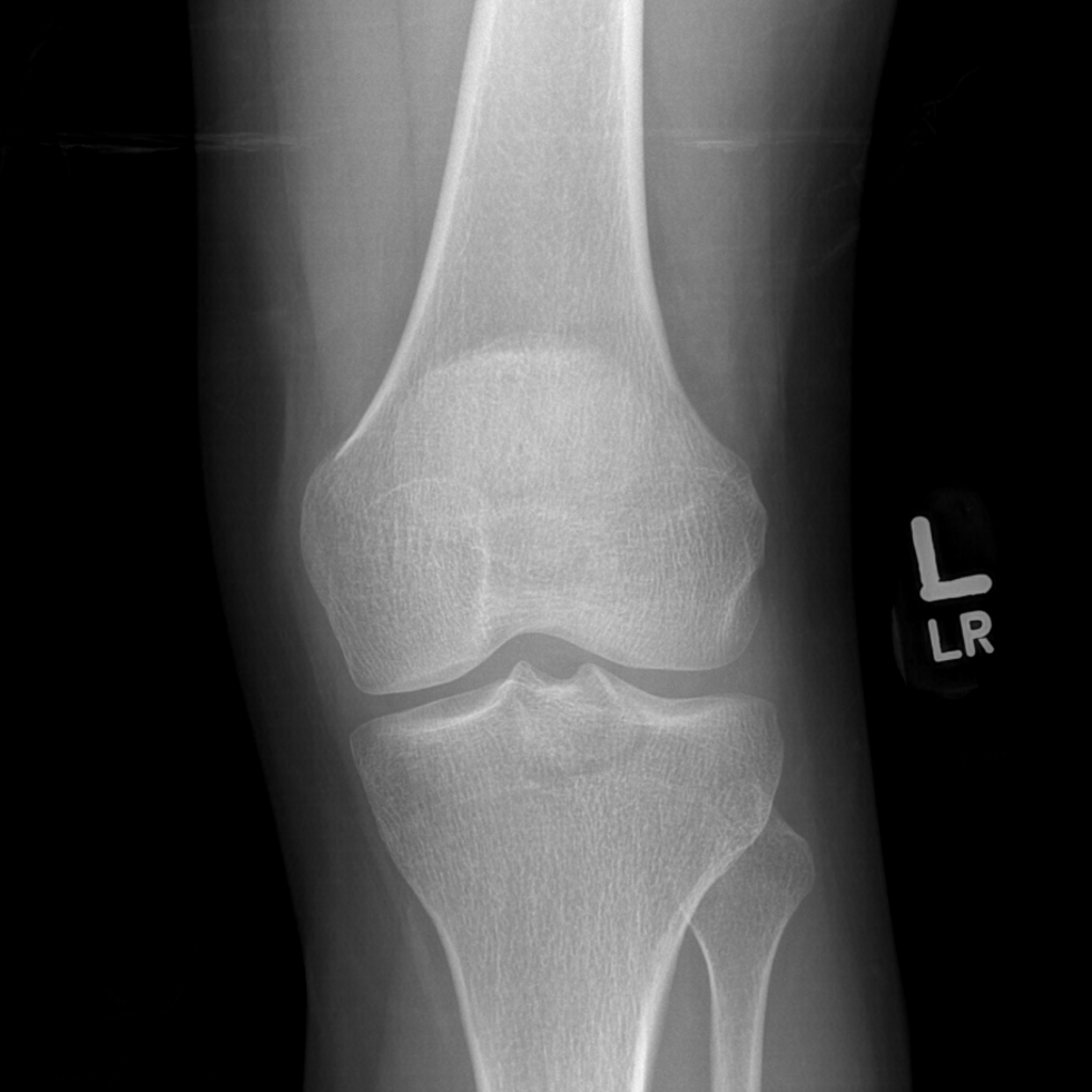 Rupture du LCP avec fracture