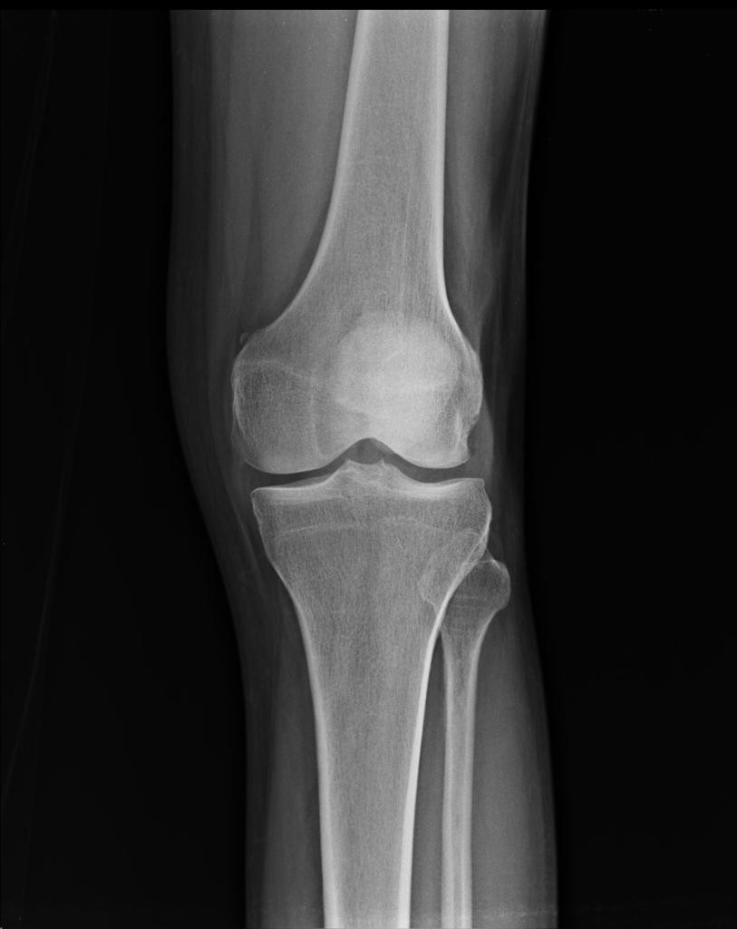 Calcification de Pellegrini Stieda