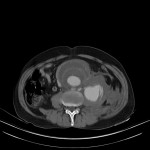 Rupture d'un anévrisme de l'aorte abdominale