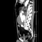 Rupture d'un anévrisme de l'aorte abdominale