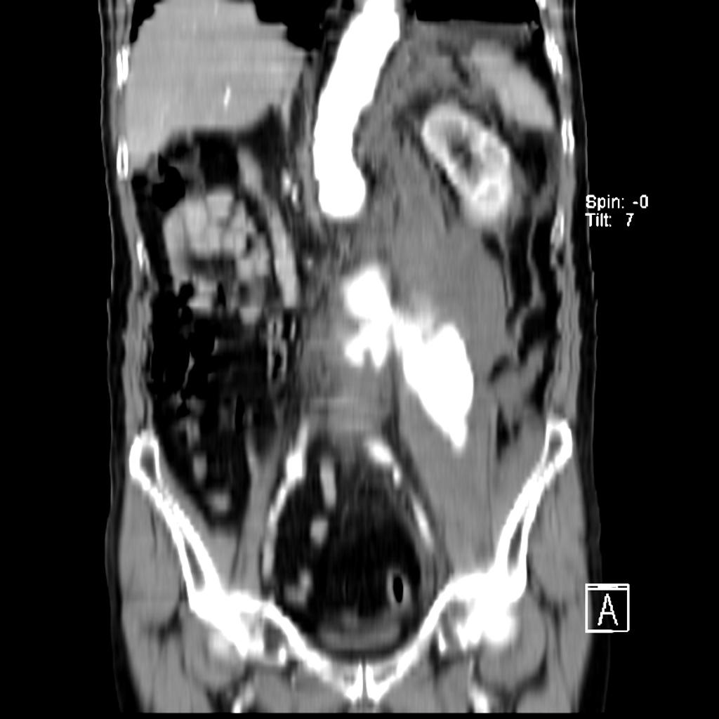 Rupture d'un anévrisme de l'aorte abdominale