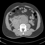 Rupture d'un anévrisme de l'aorte abdominale