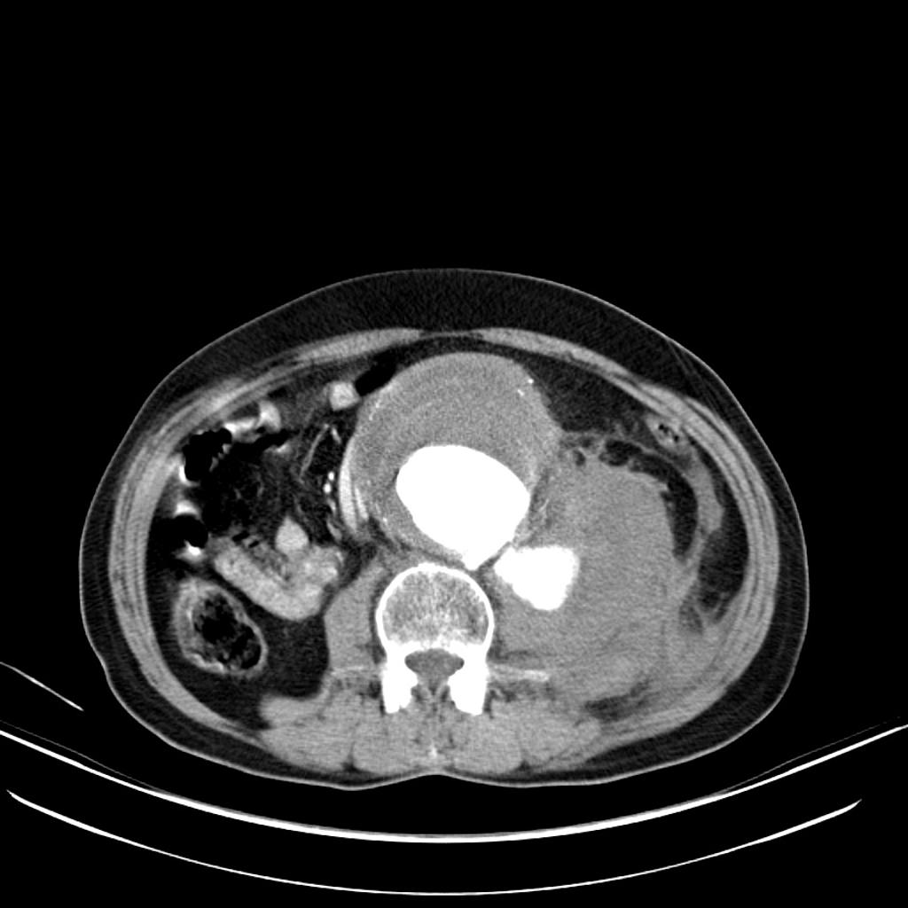 Rupture d'un anévrisme de l'aorte abdominale