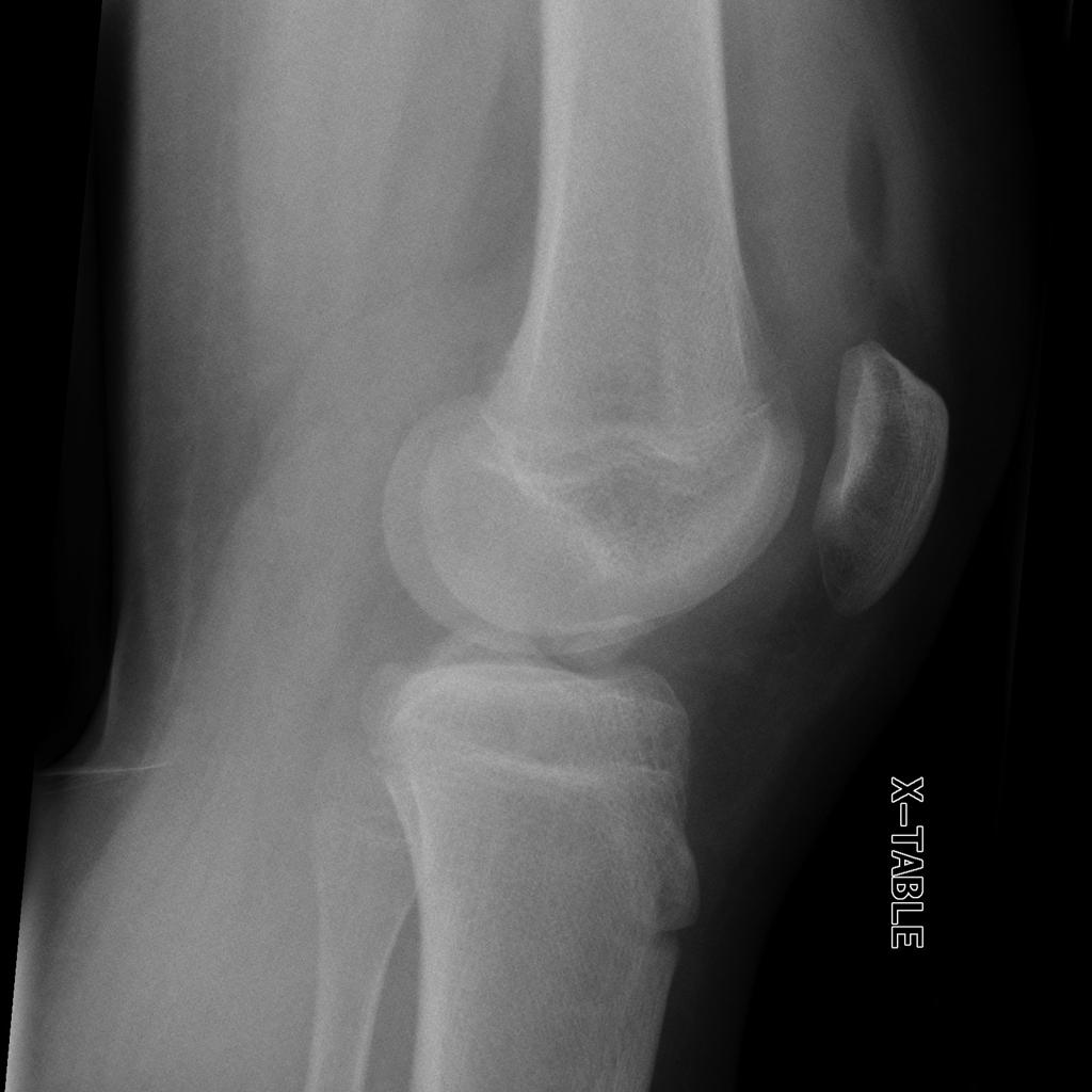 Fracture de Second avec rupture du LCA