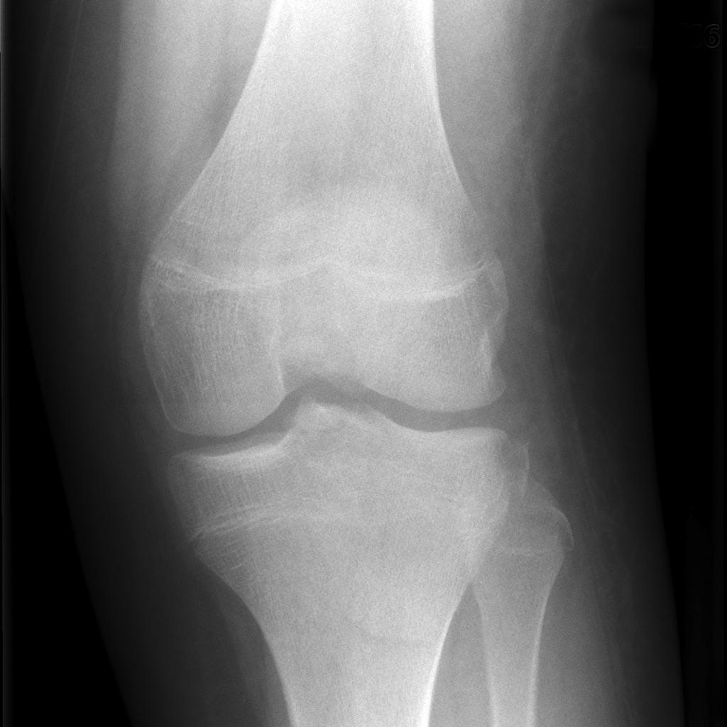 Fracture de Second avec rupture du LCA