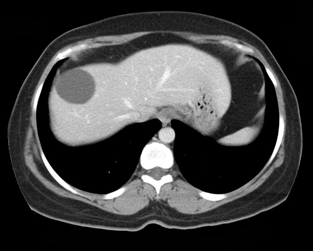 Liver Cyst Mri