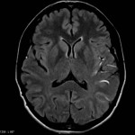 AVC : hypersignaux FLAIR des vaisseaux sylviens gauches en rapport avec un ralentissement vasculaire