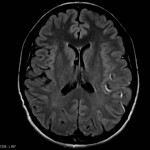 AVC : hypersignaux FLAIR des vaisseaux sylviens gauches en rapport avec un ralentissement vasculaire