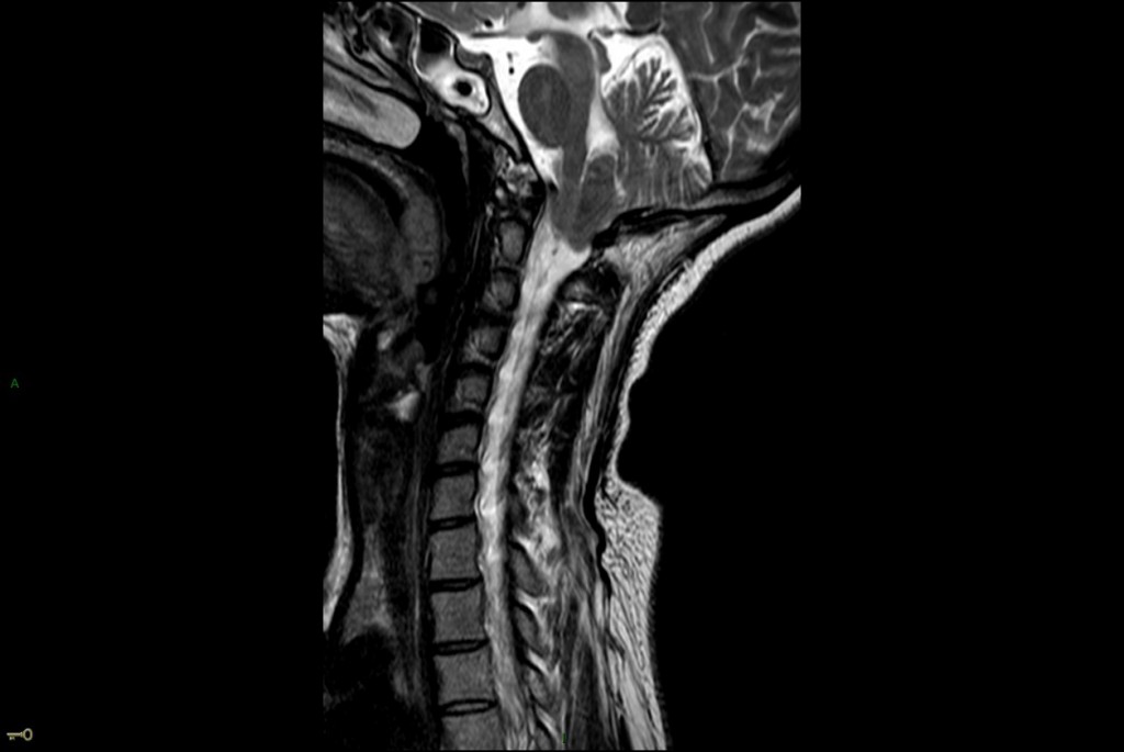 Chiari 1