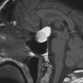 Craniopharyngiome