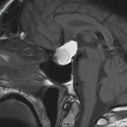 Craniopharyngiome